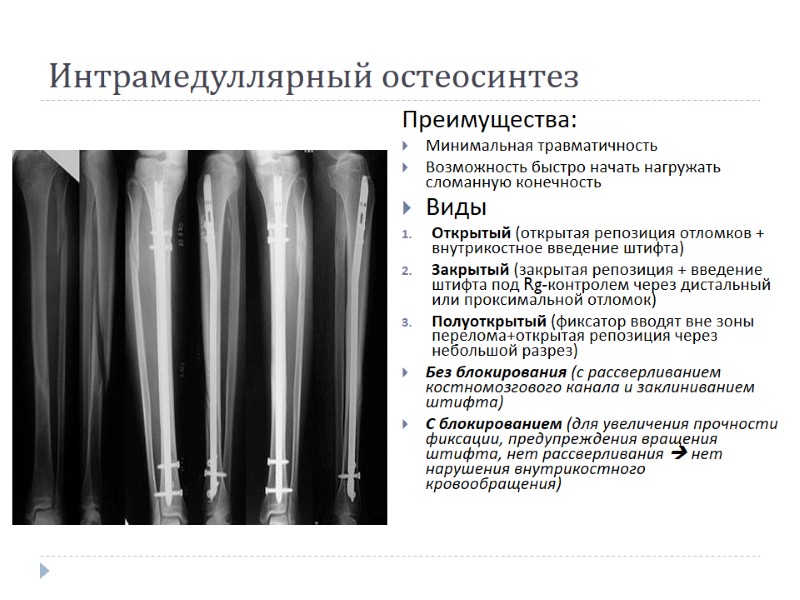 Интрамедуллярный остеосинтез Преимущества: Минимальная травматичность Возможность быстро начать нагружать сломанную конечность  Виды Открытый